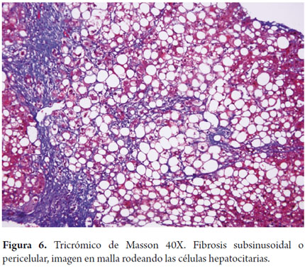 Fibrosis sinusoidal jpg