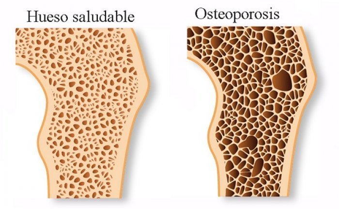 hueso normal osteporosis