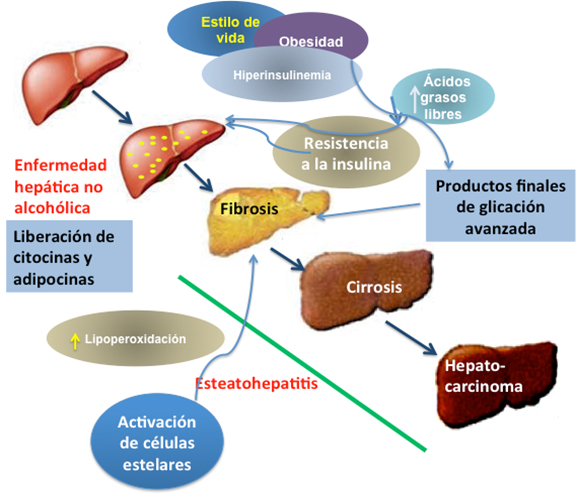Progresion esteatosis fibrosis