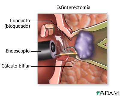 esfinterectomia