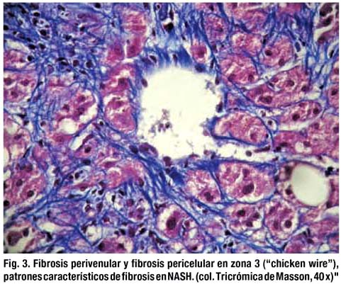 Células rodeadas de fibrosis
