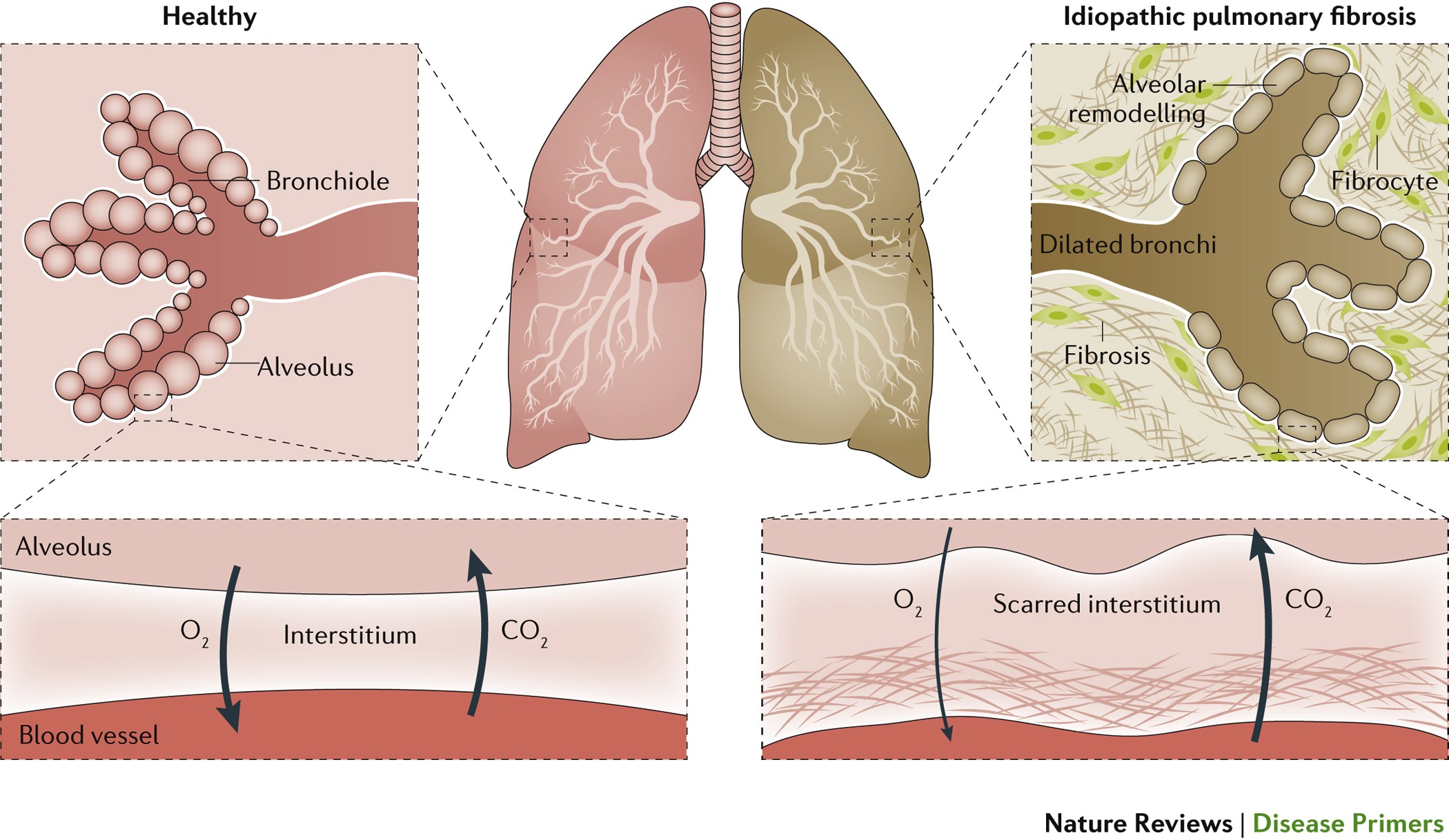 Fibrosis pulmonar Nature