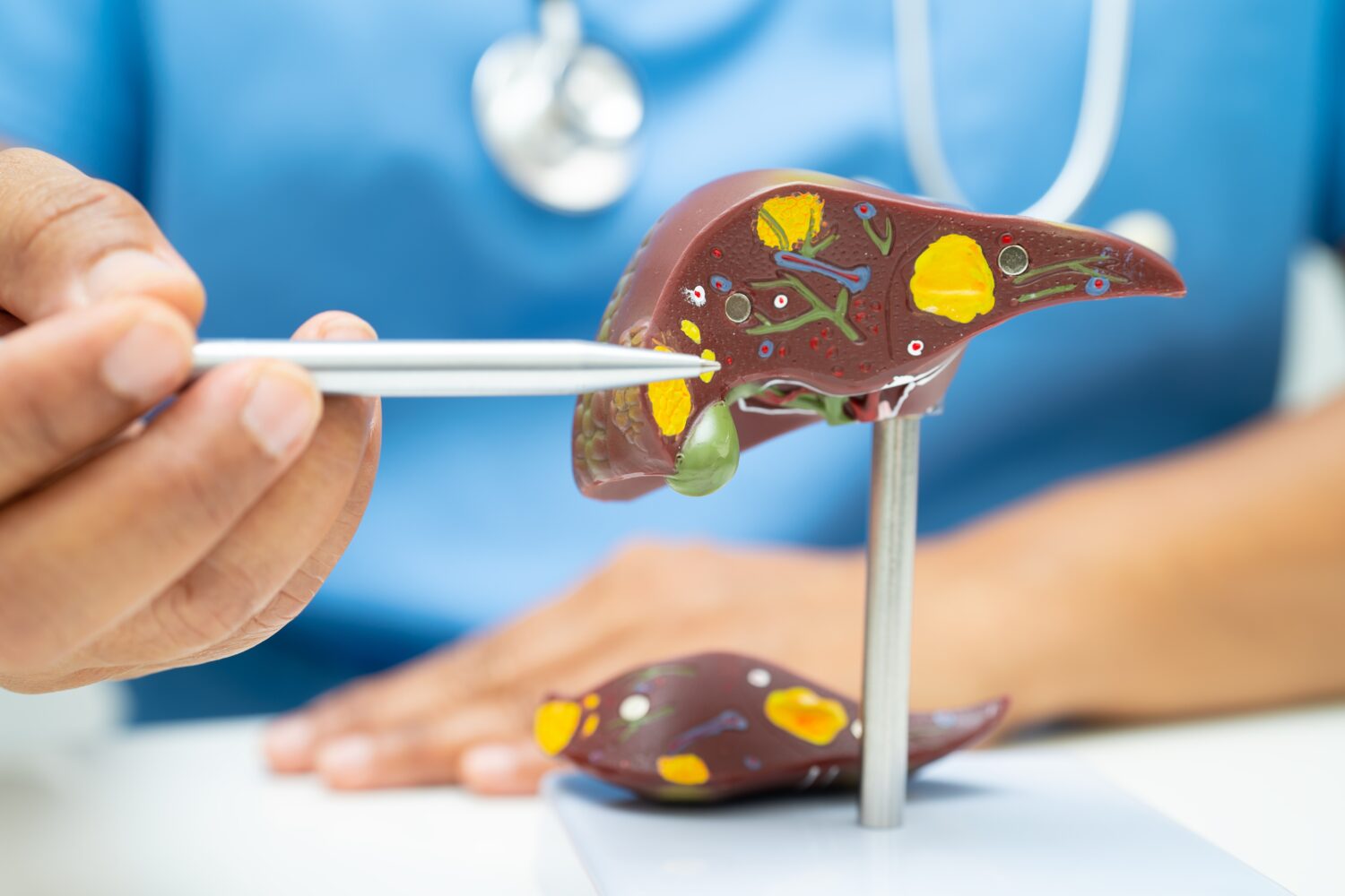 Aprendiendo de un estudio sueco con pacientes con Enfermedad Hepática por Esteatosis Metabólica
