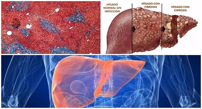 Diagnóstico y Tratamiento Fibrosis Hepática