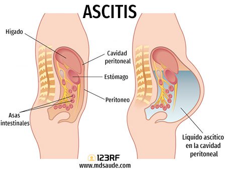 ascitis ilustracion