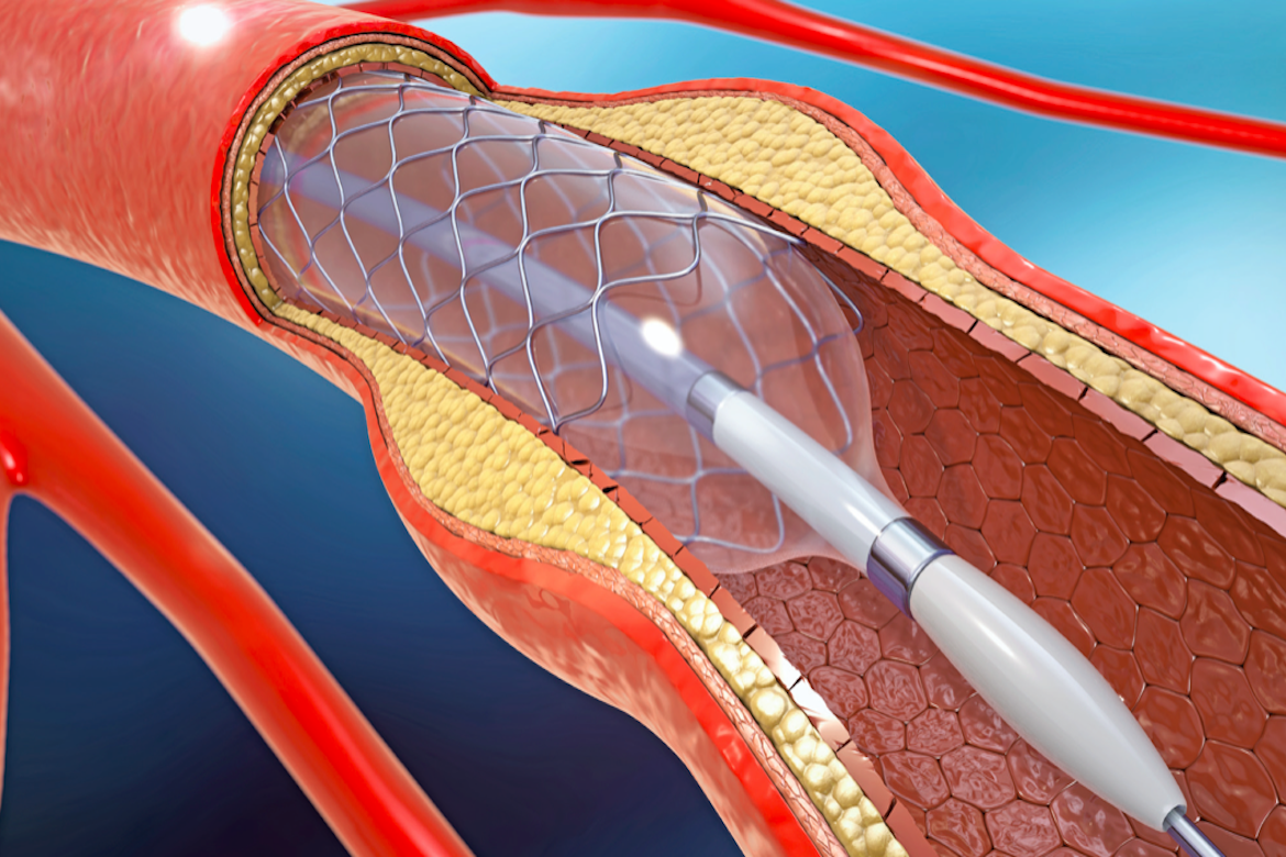 stent cardiaco