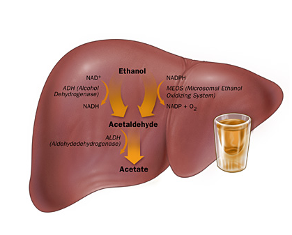 alcoholic liver disease