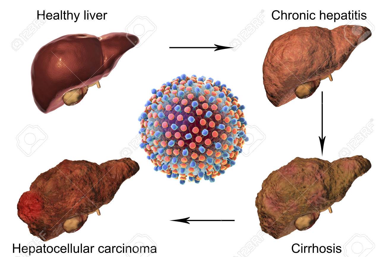 Virus carcinoma