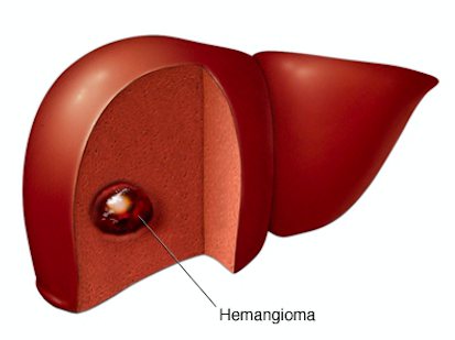 anatomia hemangioma hepatico