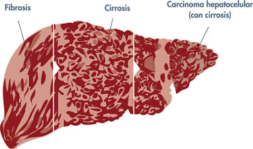 prediccion fibrosis cirrosis cancer