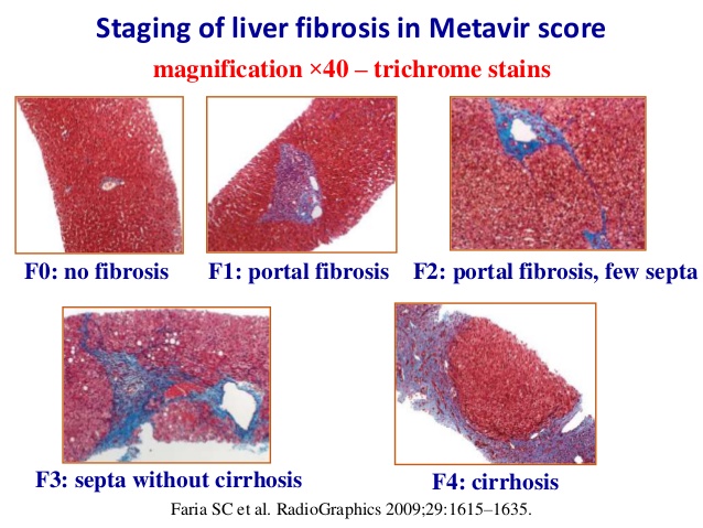 assessment of liver fibrosis by us elastography 2 638