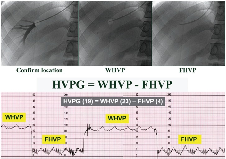 hepatic venous pressure gradient
