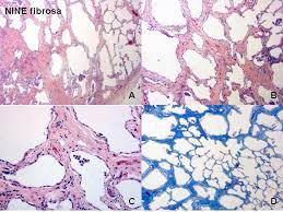 lung fibrosis 10